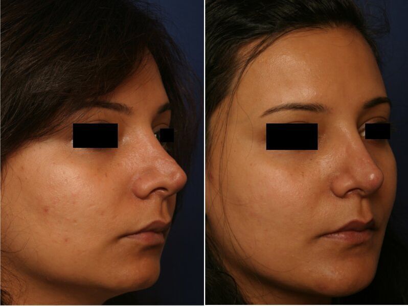 plastik cerrahi sonucu