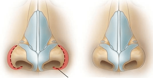 Burun deliği küçültme