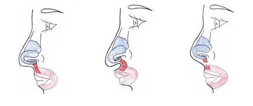 Burun kasının bir kısmının kesilmesi