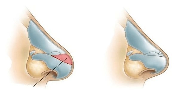 Burun şekli düzeltme