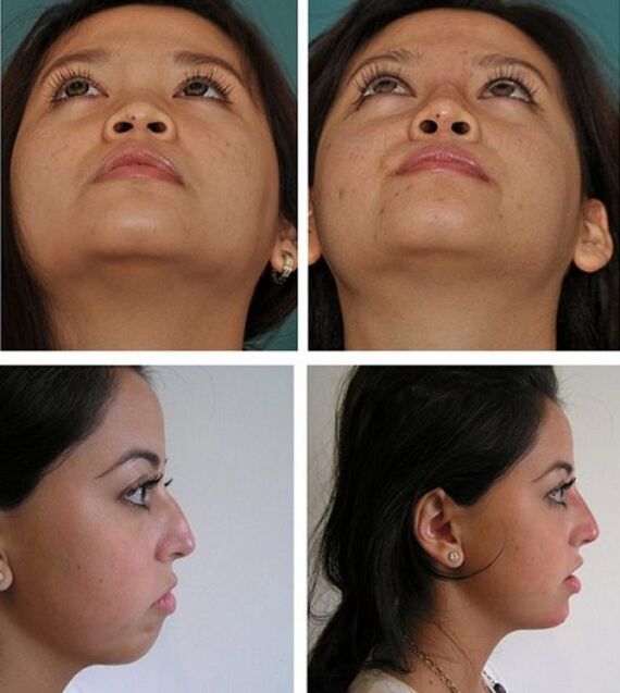 ameliyatsız burun estetiği öncesi ve sonrası fotoğraflar