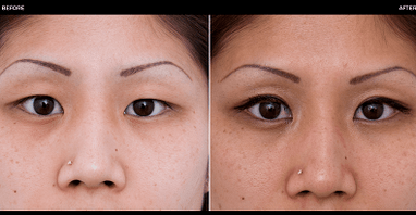 göz ameliyatı öncesi ve sonrası
