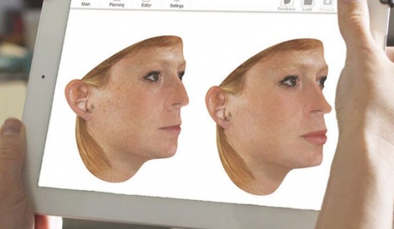 Rinoplasti öncesi burnun bilgisayar modellemesi yöntemi