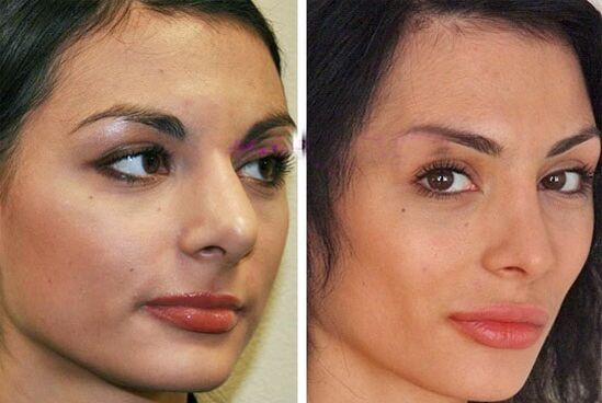 estetik ameliyat öncesi ve sonrası burun