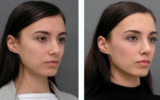 Kız önce ve sonra rinoplasti burun